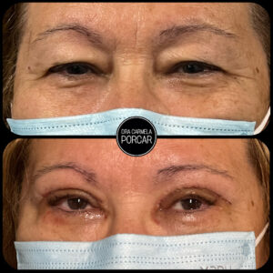Dra Carmela Porcar - Oftalmología Zaragoza- Blefaroplastia Zaragoza