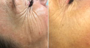 Clínica Dra Pilar Moreno ,adultos y miños.Caída del pelo hombres y mujeres.Cosmetica y medicina estética Acné