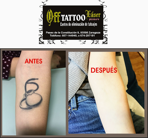Eliminación de Tatuajes y micro pigmentación Off Tattoo-láser